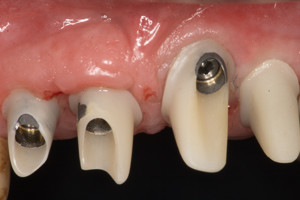 Зъбни импланти