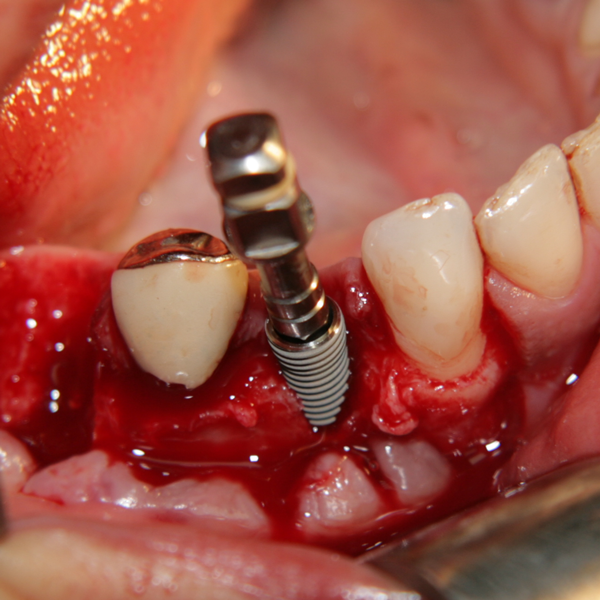 Зъбен имплант при поставяне