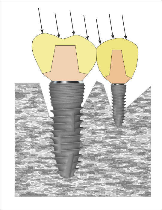 Костна резорбция при имплантите с различен размер