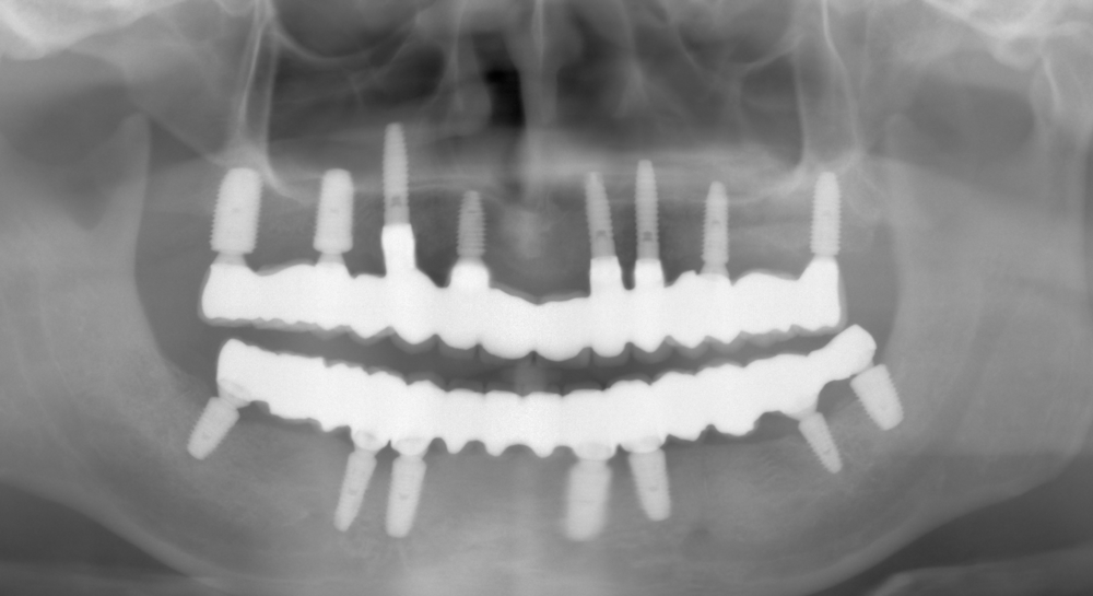 Зъбни импланти с мостова конструкция