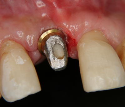 Зъбен имплант с надстройка