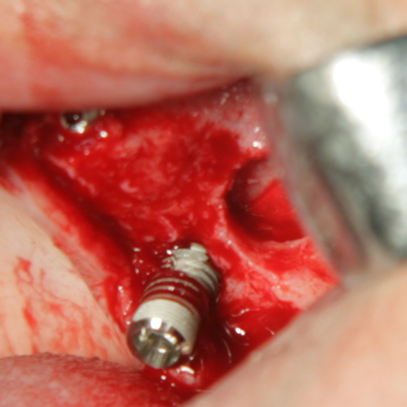 Зъбен имплант с костна пластика