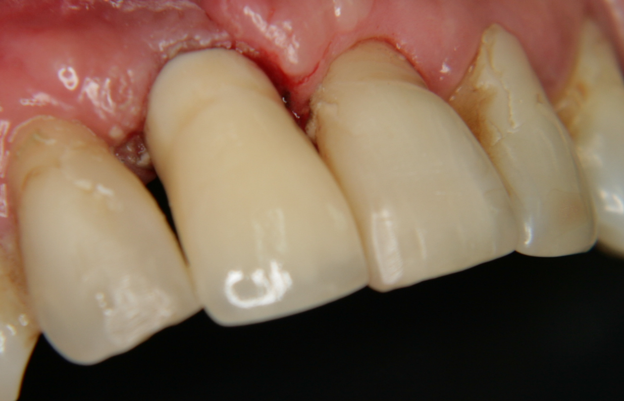 Зъбен имплант с корона