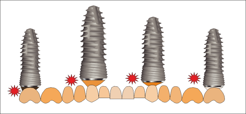 Зъбни импланти - четири броя