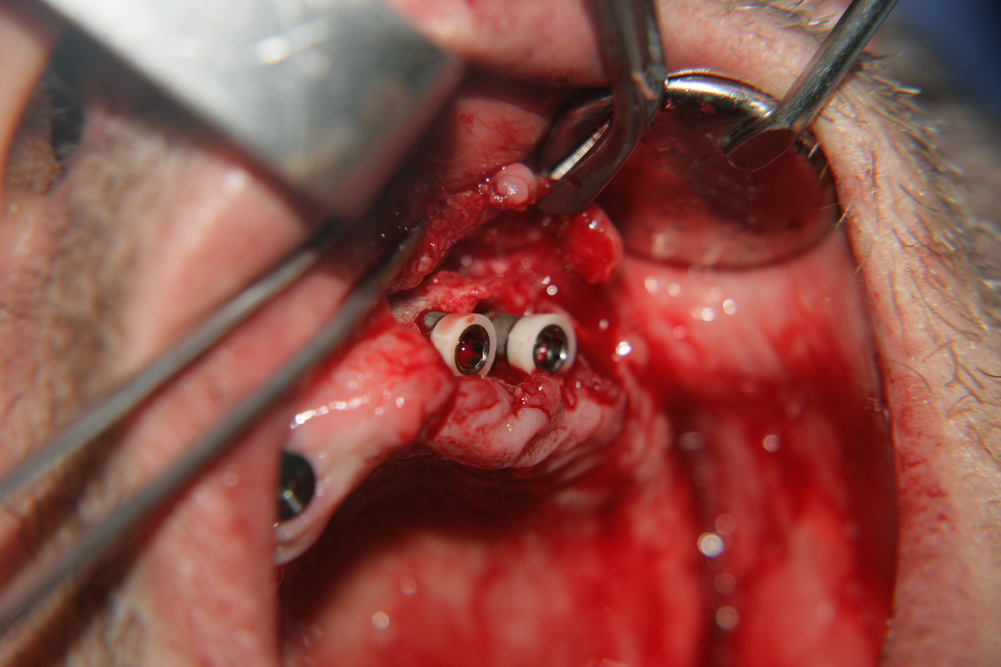 Зъбни импланти с керамичен гингивален пръстен