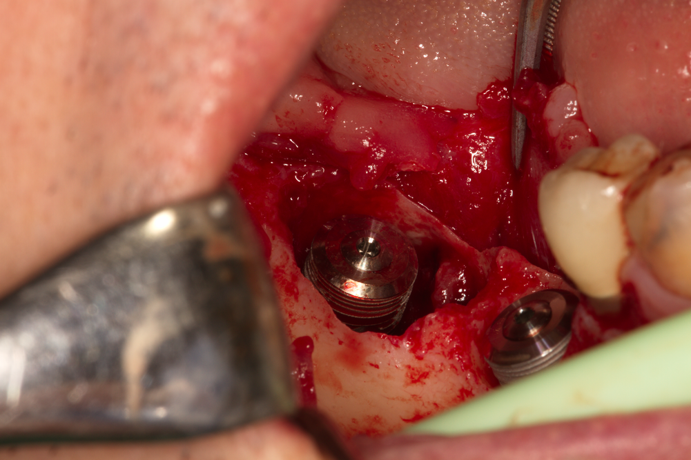 Зъбни импланти с костен дефект около тях