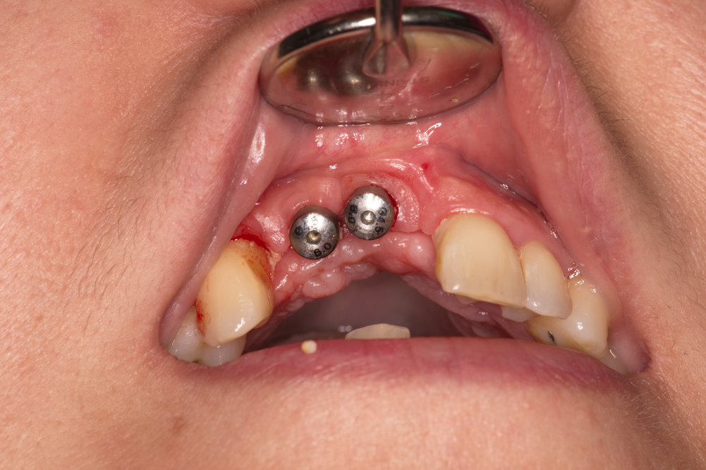 Зъбни импланти с гингивооформителни винтове