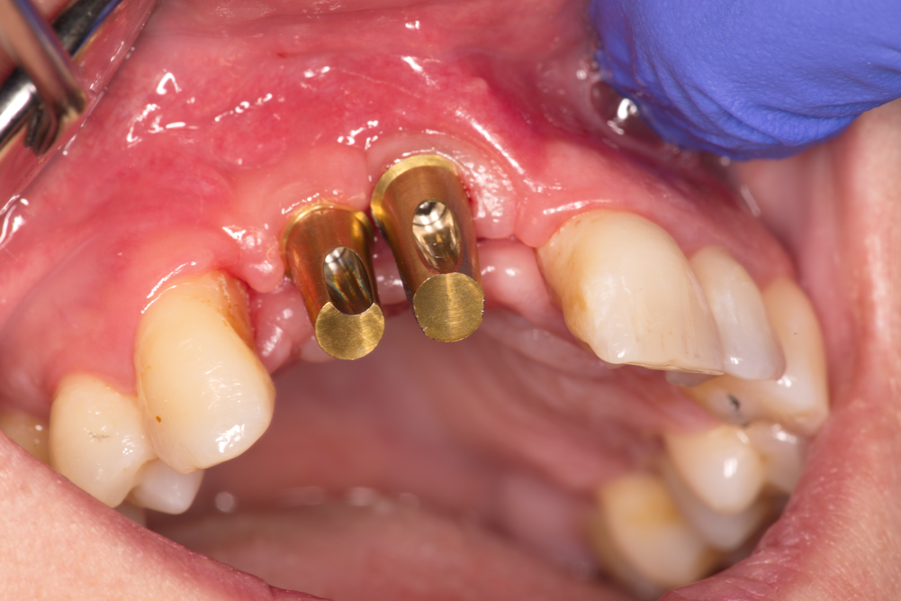 Зъбни импланти с поставени надстройки
